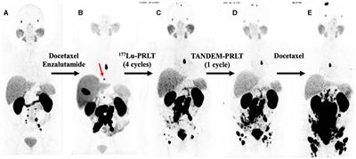 Extraordinary therapeutic effect of PSMA radioligand therapy in treatment-refractory progressive metastatic prostate cancer with the transketolase inhibitor benfo-oxythiamine as a radiosensitizer—A case report